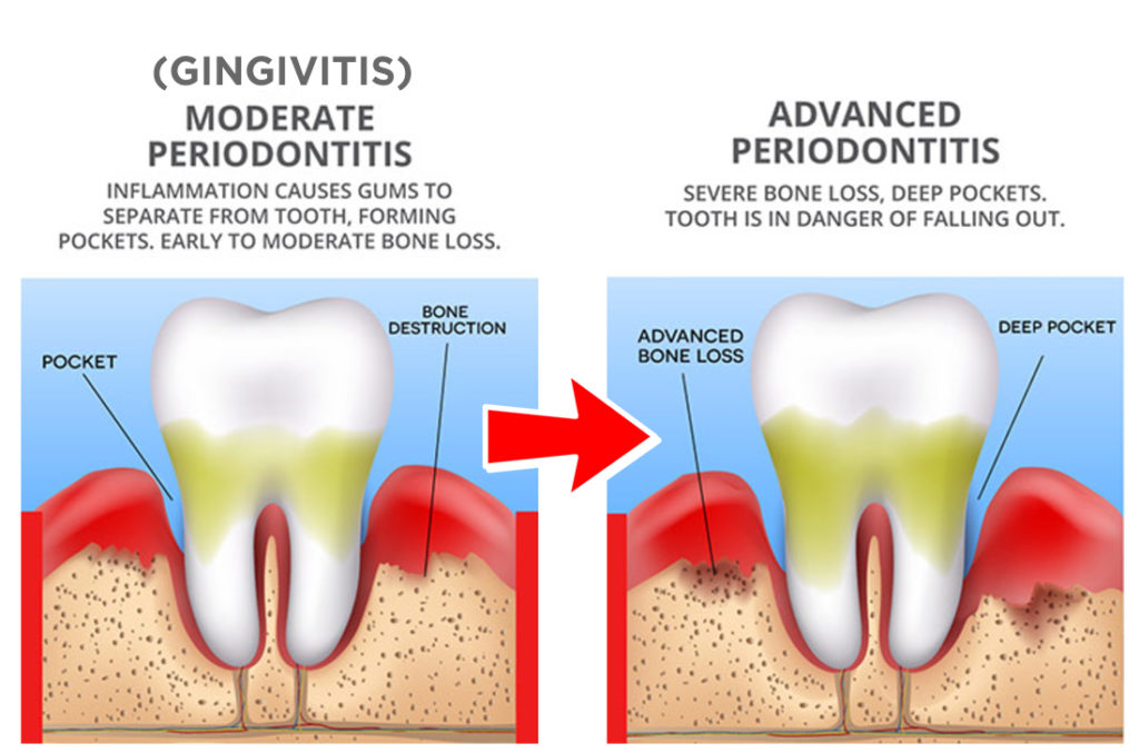 What Is Gingivitis? – 20/20 Dentistry